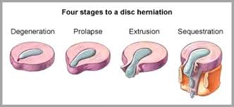 4 stges to disk herniation