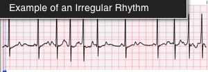 EKG-irregular