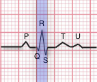 EKG-QRSinterval